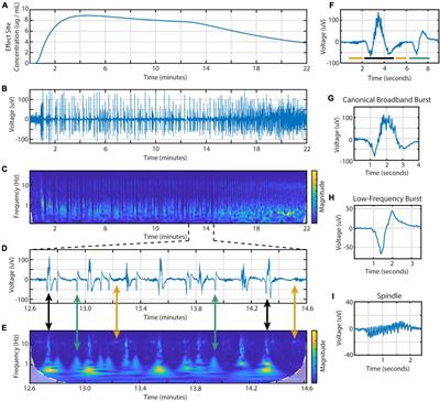 Diversity of electroencephalographic patterns during propofol-induced burst suppression